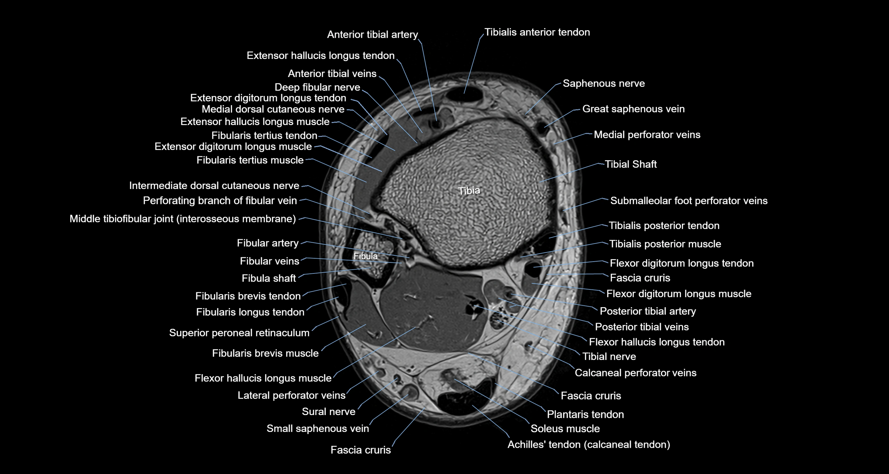 Ankle axial anatomy 3T MRI images -img-10001-00005.webp